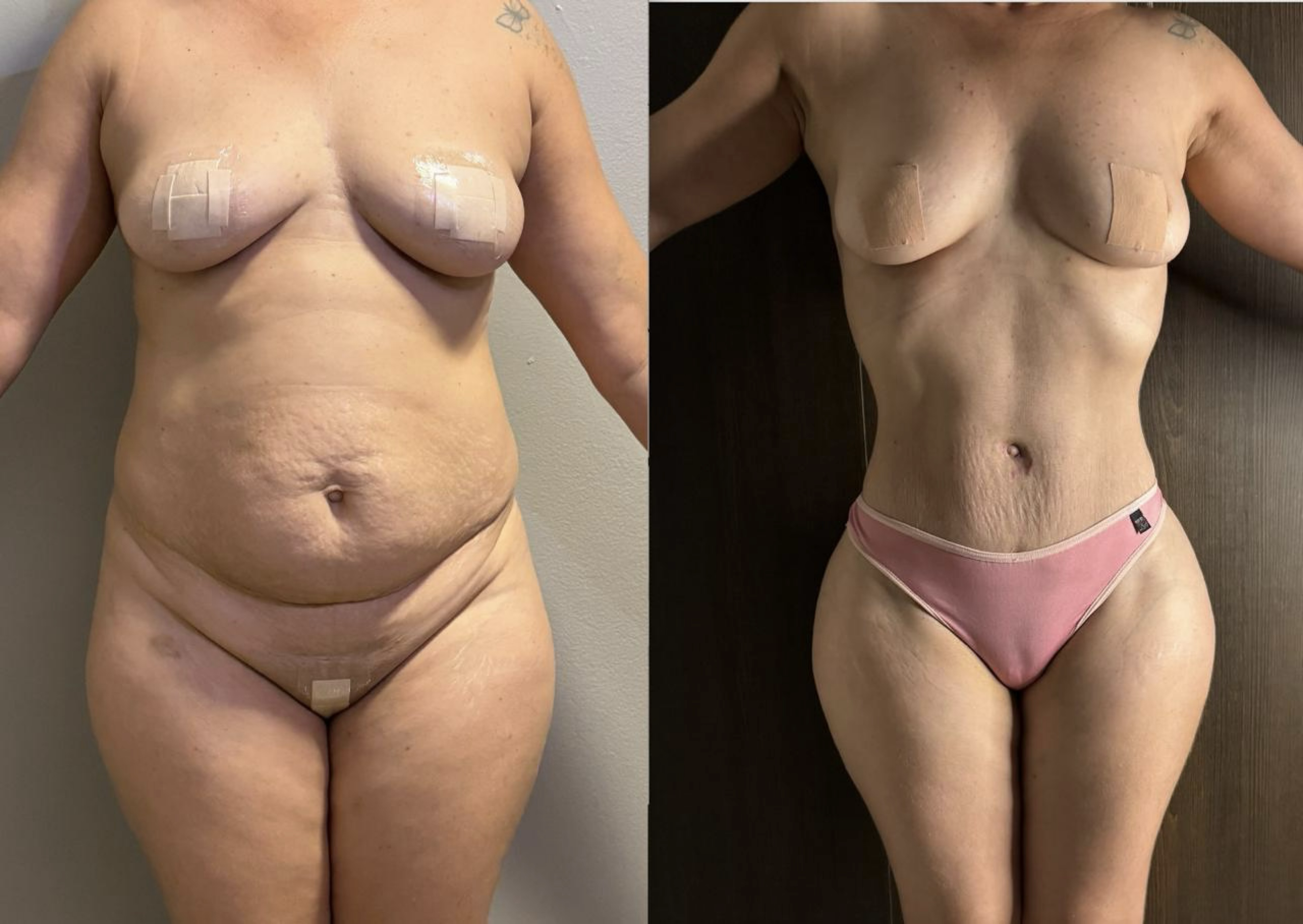 Resultado Paciente Modelo - Frente